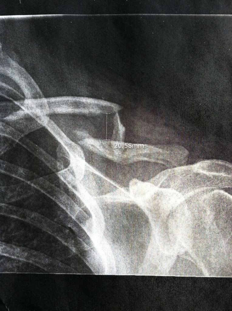 broken bone x-ray | PNW Riders - The Motorcycle Community for the