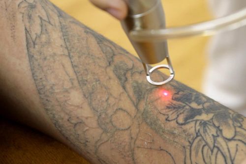 [Image: Xoa-hinh-xam-bang-laser_zpslo7igknx.jpg]