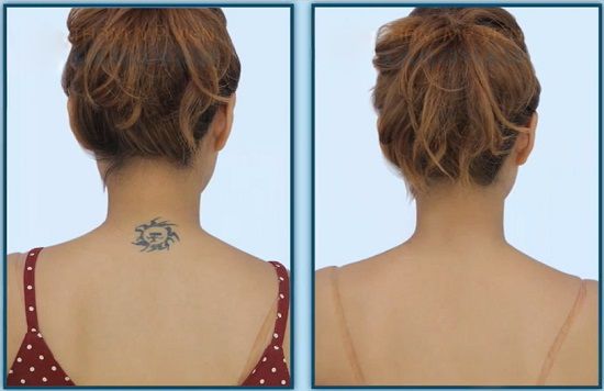 [Image: xoa-xam-bang-laser_zpsad92264d.jpg]