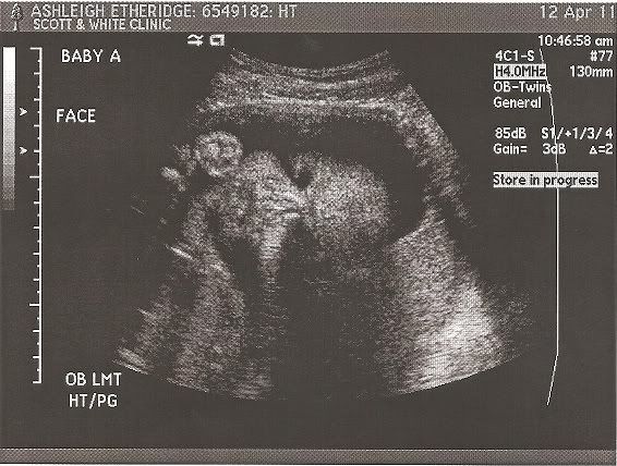 12 5 week ultrasound. To: ALL Posted: Apr-12 03:41
