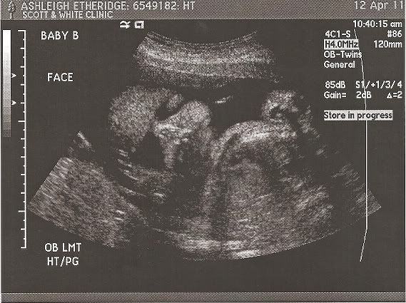 12 5 week ultrasound. To: ALL Posted: Apr-12 03:41