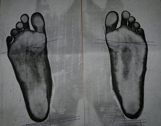 Adult Acquired Flat Feet